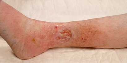 Venous Leg Ulcer
