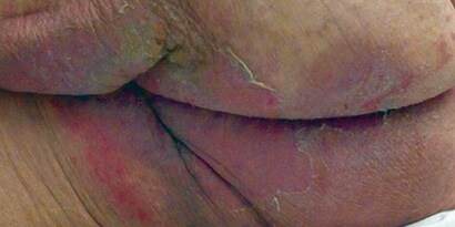 Moisture-associated skin damage patient image
