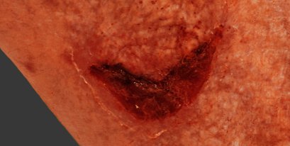 Skin tear
