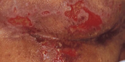 Pressure Ulcer Pressure Injury
